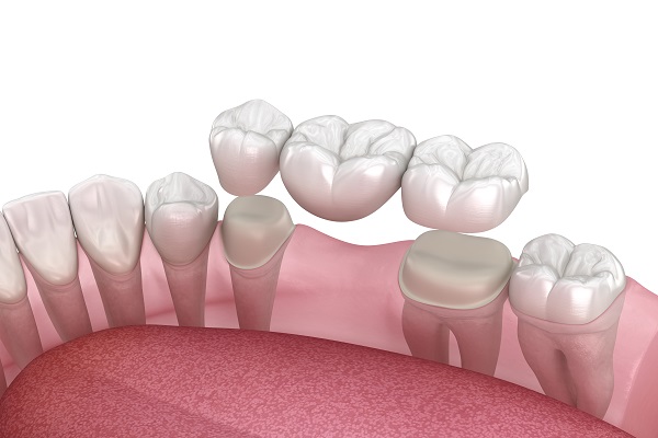 Dental Bridges Can Replace Missing Teeth