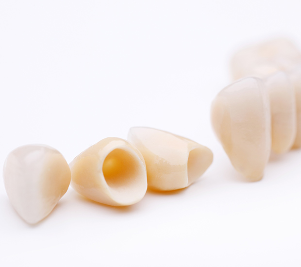 Santa Clara Dental Crowns and Dental Bridges