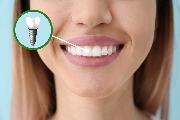 What To Ask Your General Dentist About Multiple Dental Implants