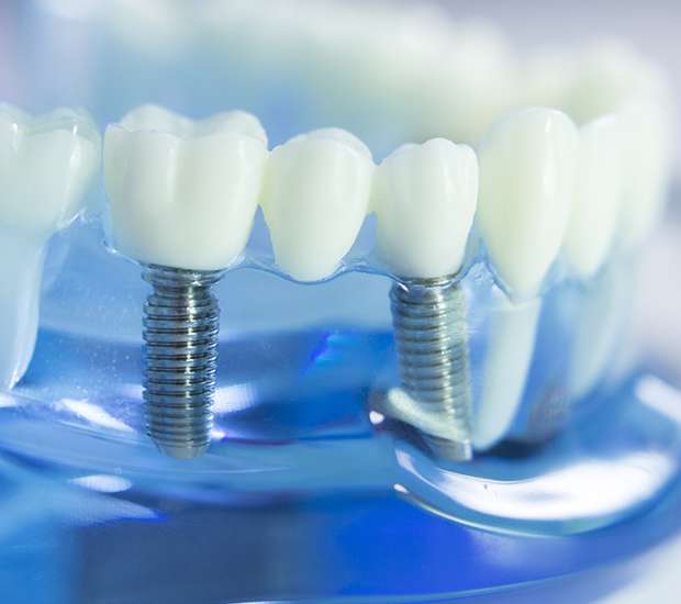 Santa Clara Dental Implants