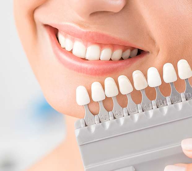 Santa Clara Dental Veneers and Dental Laminates