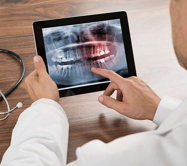 Santa Clara Types of Dental Root Fractures